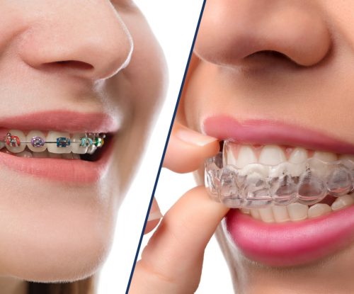 braces-vs-invisalign-hero